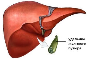 Печень после удаления желчного пузыря