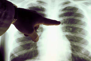 Рентгенография воспаления легких