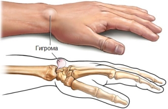 Гигрома — лечение в домашних условиях