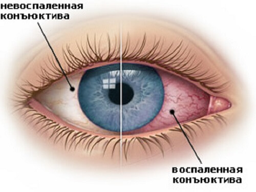 Глаз человека при конъюнктивите симптомы