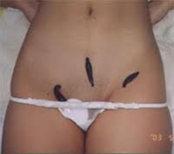 пиявки на девушке