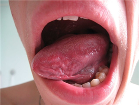 Лечение герпеса на языке