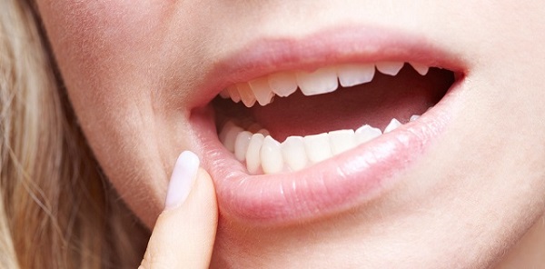 Локализованный ювенильный пародонтит заболевание полости рта