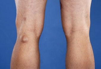 Киста Бейкера коленного сустава — лечение народными средствами