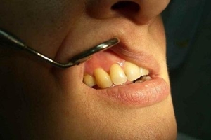 Чем опасна киста на зубе
