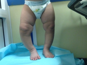 Кривые ноги у ребенка: причины, лечение
