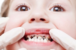 Реминерализация детских зубов