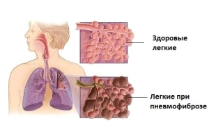 Классификация заболевания