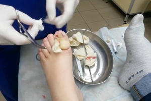 Все методы лечения вросшего ногтя