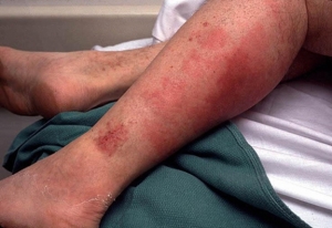 Симптомы рожистого воспаления ноги