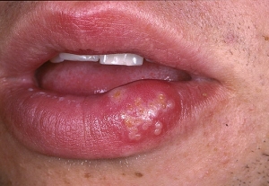 Простуда на губах вызывается герпесвирусом