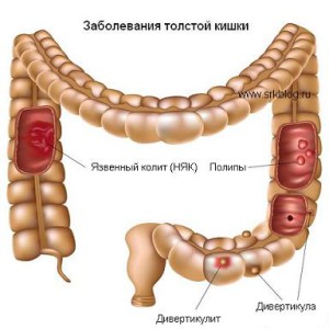 няк лечение народными средствами