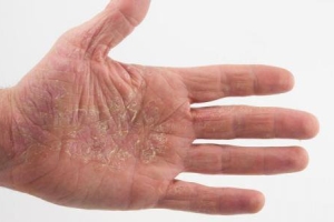 Заболевание кожи нейродермит