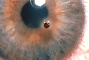 Виды и симптомы травматического повреждения глаза
