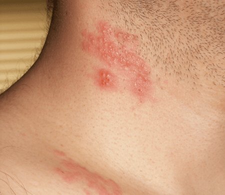 Опоясывающий лишай: лечение ацикловиром Опоясывающий лишай ацикловиром