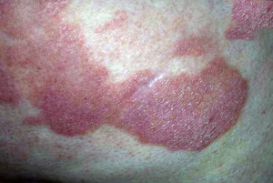 Стадии грибка в паху