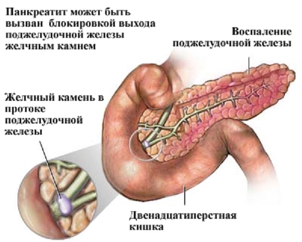 Виды панкреатита 