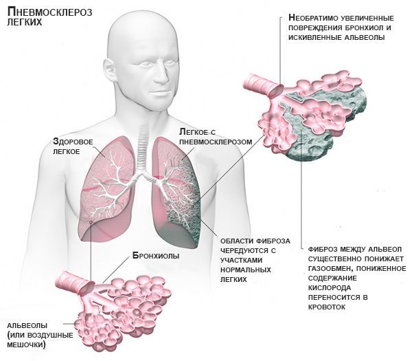 Пневмосклероз – что это такое