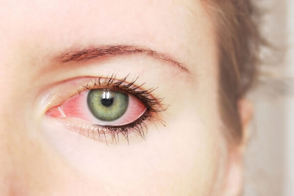 Покраснение глаз причины и лечение 