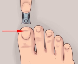 Профилактика врастающего ногтя