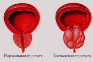 Хронический простатит