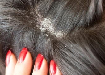 Лечение себореи кожи головы в домашних условиях