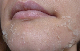 Что помогает от шелушения кожи на лице