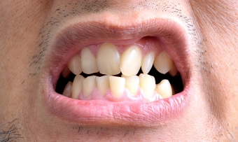 Чем можно выровнять зубы в домашних условиях