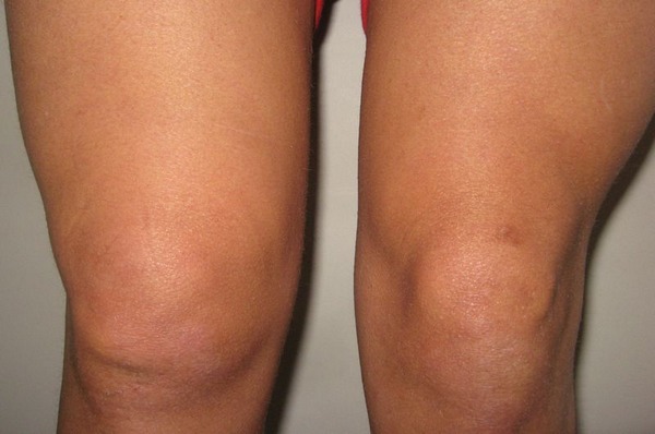 Симптомы синовита коленного сустава 