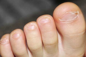 Слоение ногтей на ногах