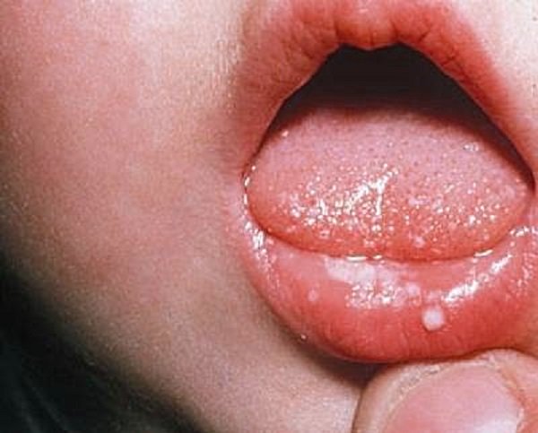 Заболевания афтозным стоматитом у детей 