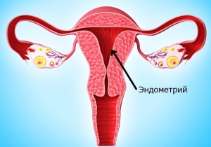 Причины истончения эндометрия