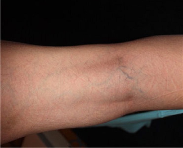 Варикоз симптомы 