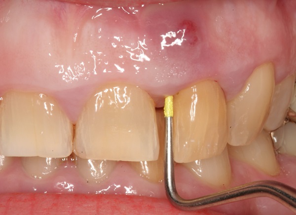 Абсцесс зуба