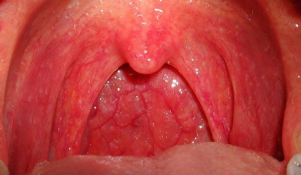 Можно ли вылечить хронический фарингит