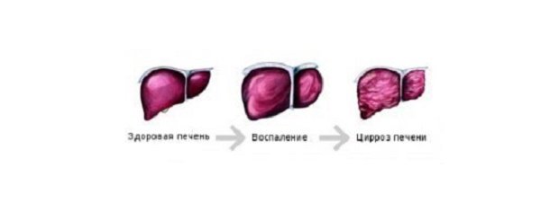 Стадии развития цирроза печени