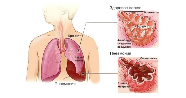 Виды пневмонии 