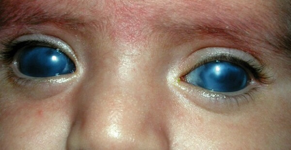 Врожденная глаукома у детей