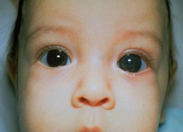 Врожденная глаукома у детей симптомы