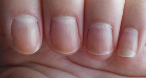 Где можно заразиться грибком ногтей пальцев рук 
