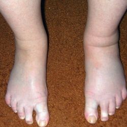Основные причины отеков ног у пожилых людей и лечение народными способами