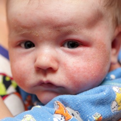 Методы лечения атопического дерматита у ребенка