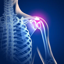 Симптомы и комплексное лечение артроза плечевого сустава