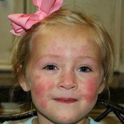 Методы лечения атопического дерматита у ребенка